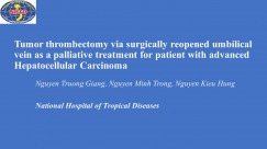 Tumor thrombectomy via surgically reopened umbilical vein as a palliative treatment for patient with advanced Hepatocellular Carcinoma