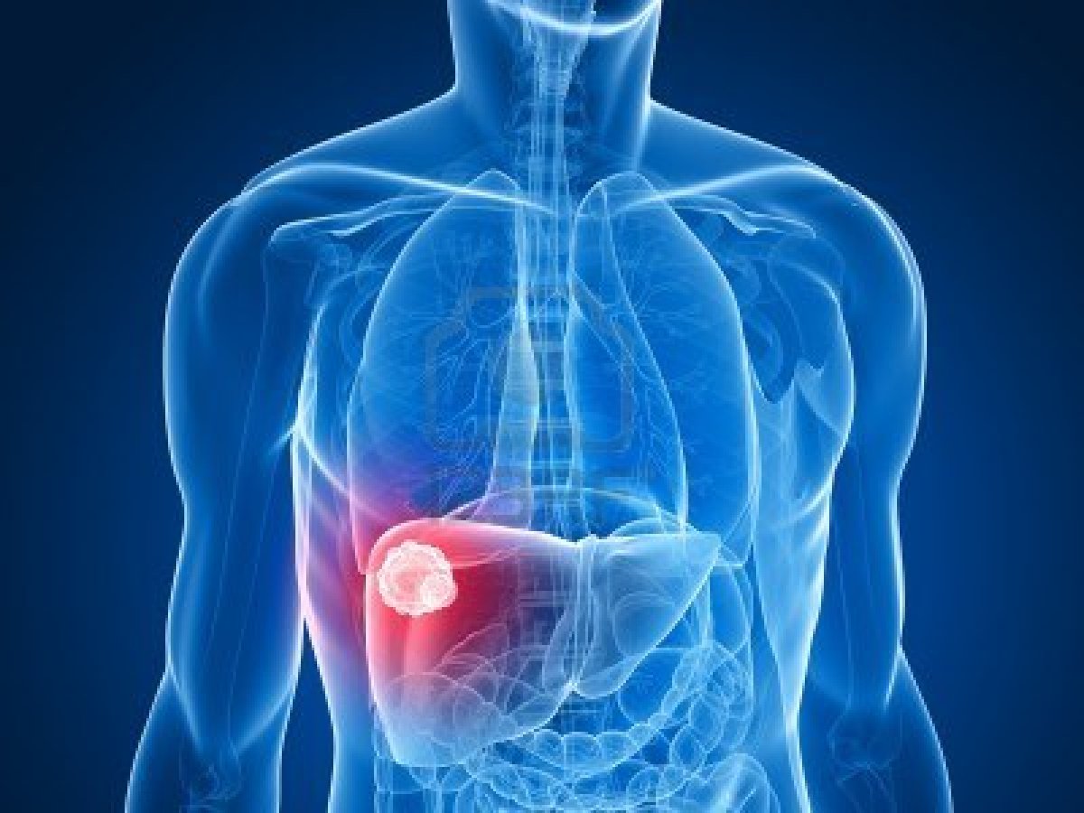 Kết quả sống thêm lâu dài của bệnh nhân ung thư biểu mô tế bào gan được điều trị bằng phương pháp tắc mạch hóa dầu và tắc mạch hóa chất sử dụng hạt vi cầu DC-Beads