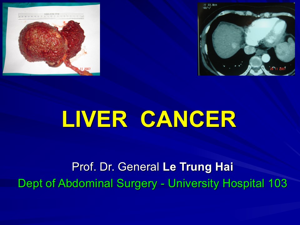 Liver cancer