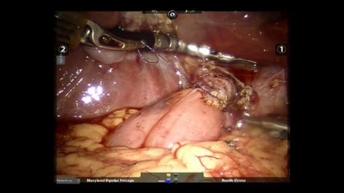 Kết quả điều trị nang ống mật chủ bằng phẫu thuật nội soi Robot cắt nang, nối ống gan chung hỗng tràng kiểu ROUX-EN-Y